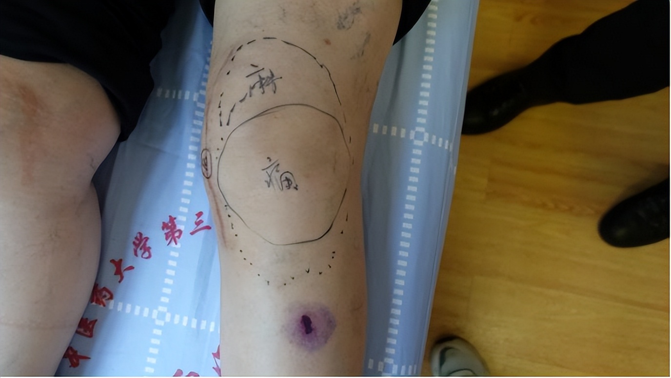 膝关节置换手术北医三院,北医三院骨关节置换手术