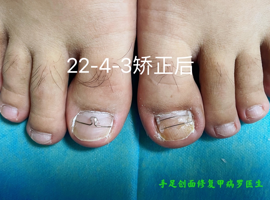 甲沟炎十年,有史以来最严重的甲沟炎