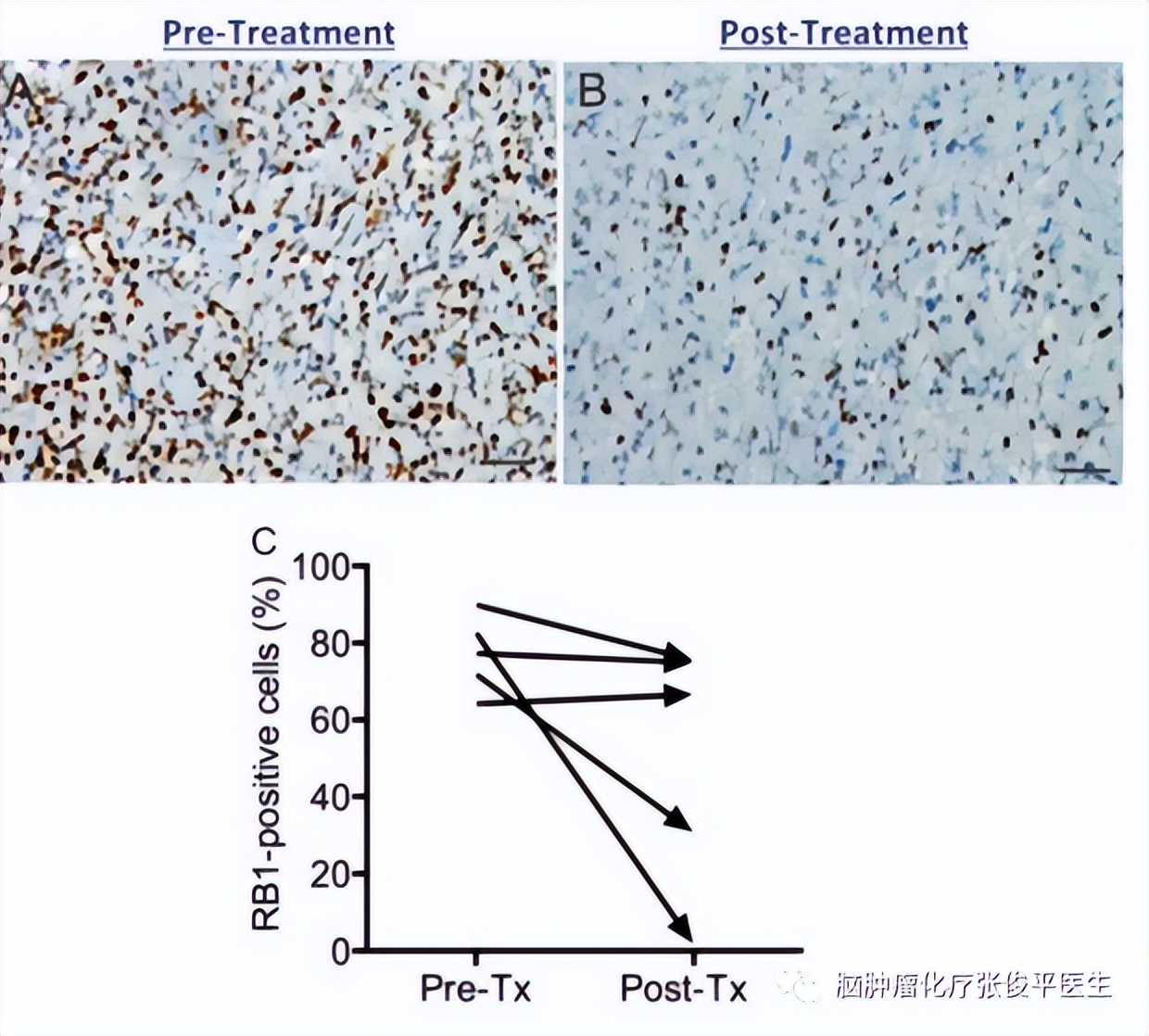 cdk4抑制剂哌柏西利,用cdk46抑制剂的都是晚期吗