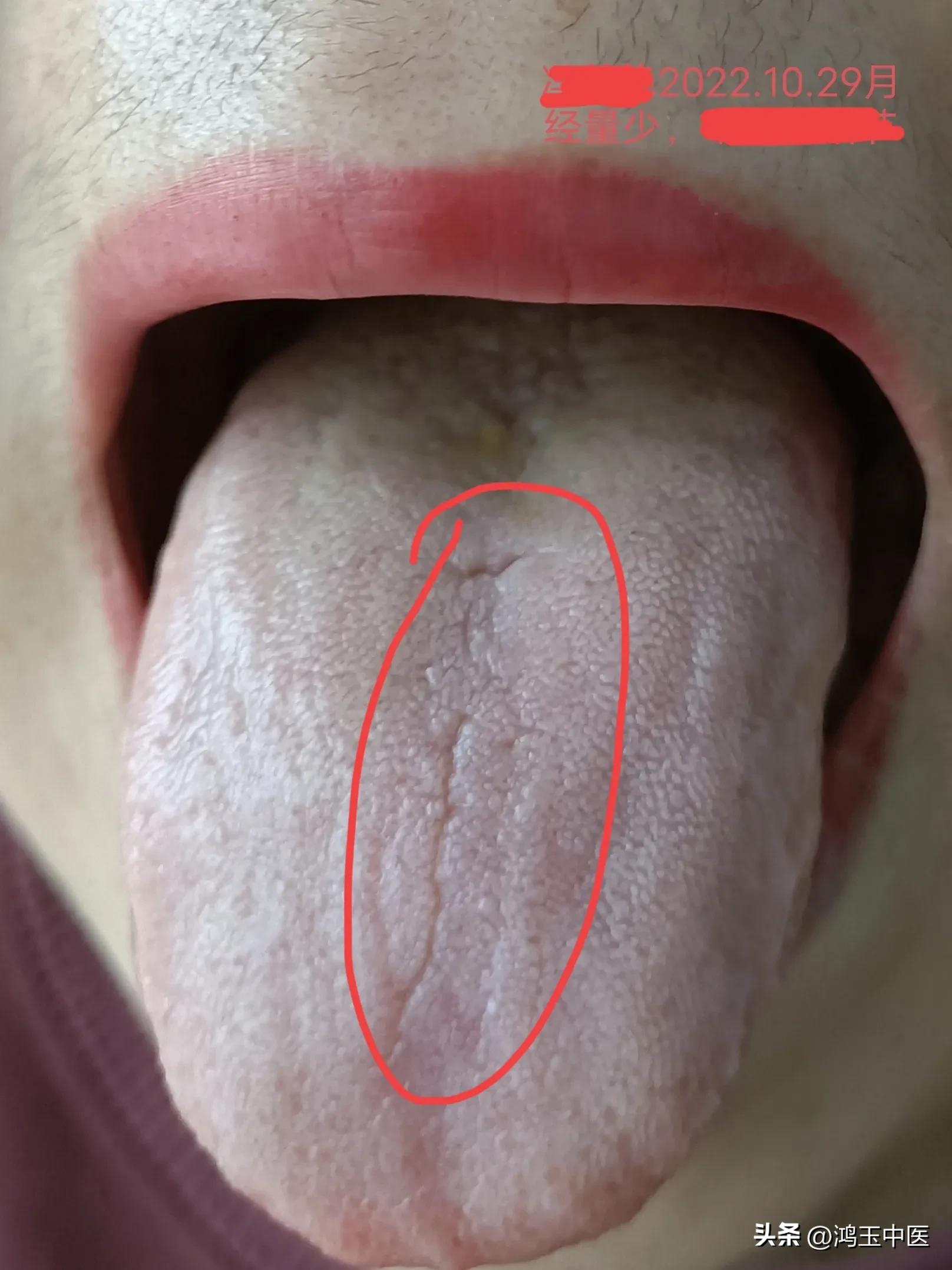 女性裂纹舌是什么原因引起的,裂纹舌影响生孩子么