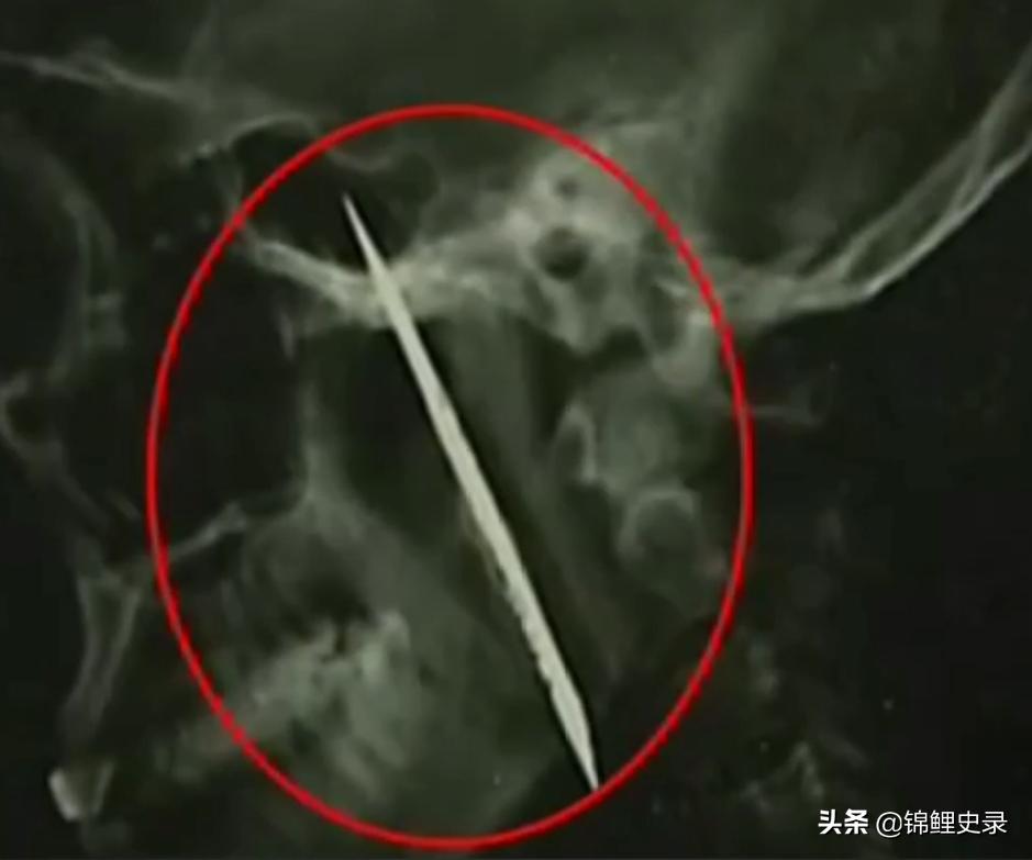 云南男子口臭骇人医生检查惊呼,云南男子口臭传奇故事