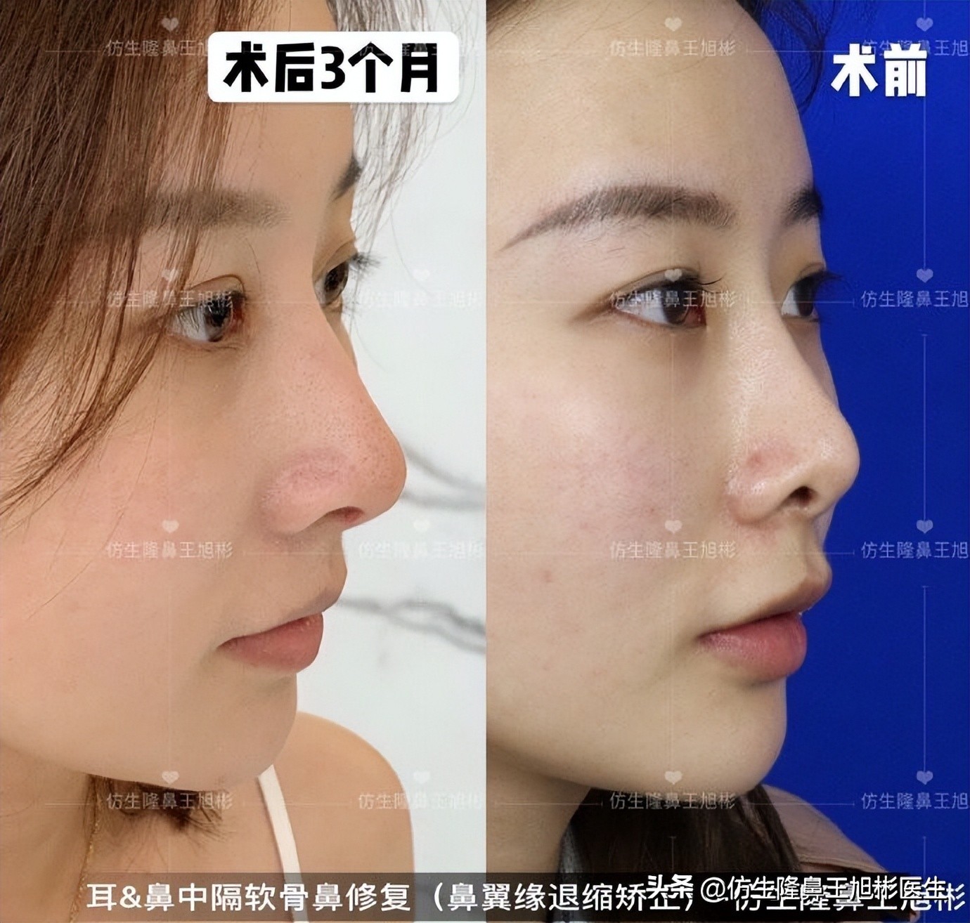 鼻尖整形最简单方法,鼻尖整形的方法图解