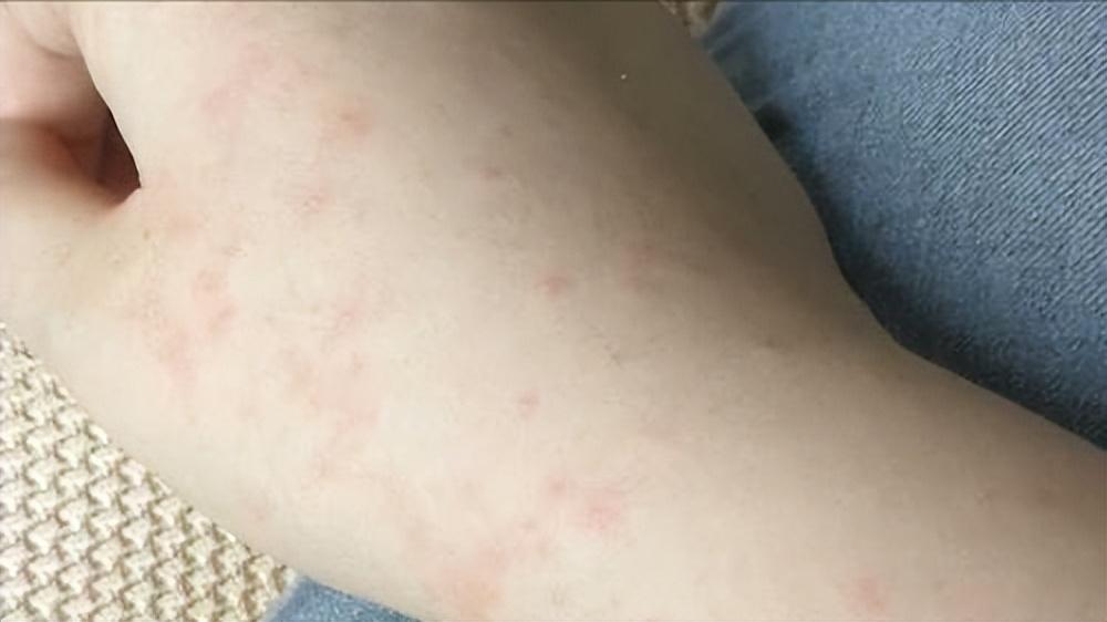 斑秃7年了用米诺地尔有效果吗 (40岁以后用米诺地尔还有效吗)