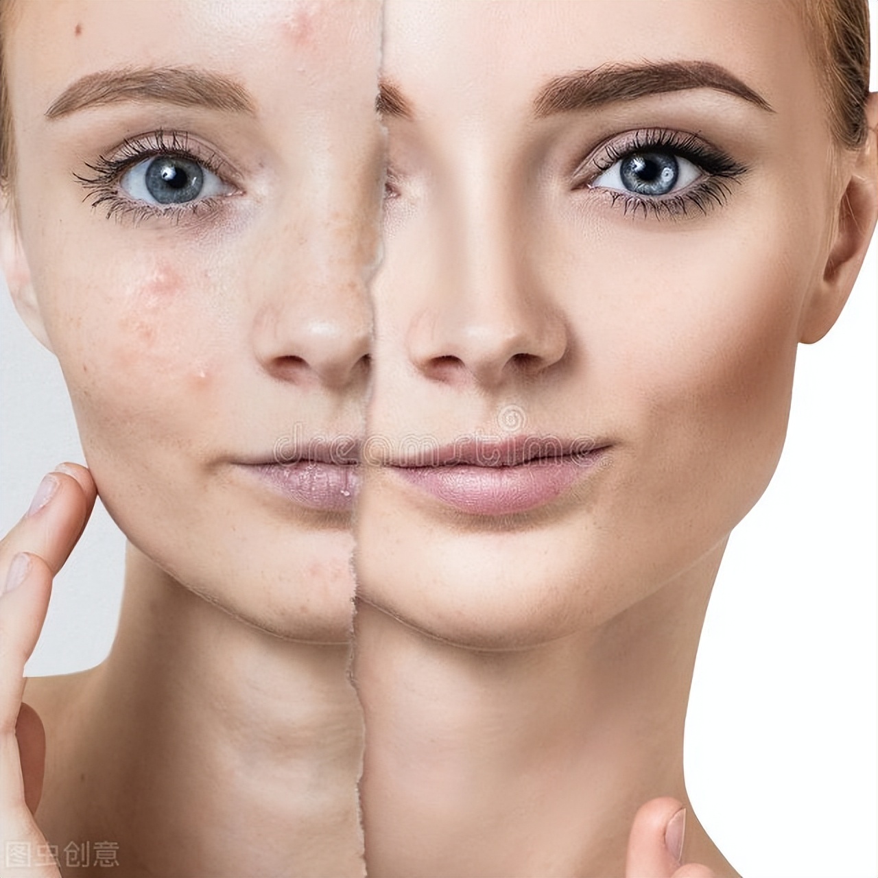 脸上长痘痘怎么调理排毒祛痘最快,脸出油多导致长痘痘如何去控油