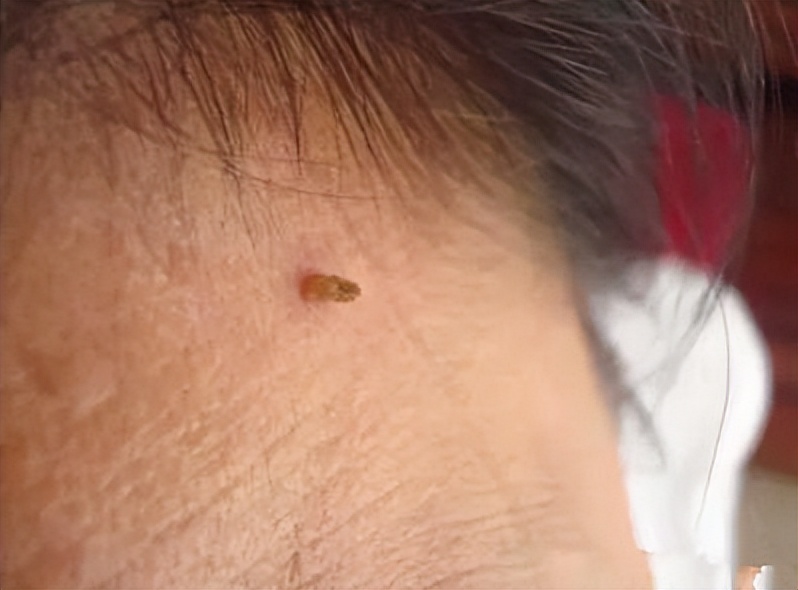 脖子和腋下的小肉粒可以揪掉吗,腋下的小肉粒能揪掉吗