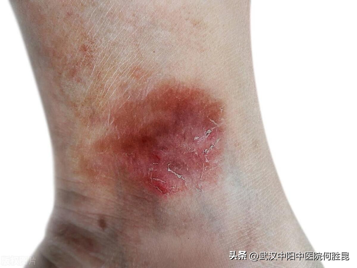 小腿皮肤和腰部皮肤瘙痒越抓越痒,腿上背上痒得很越抓越痒怎么办