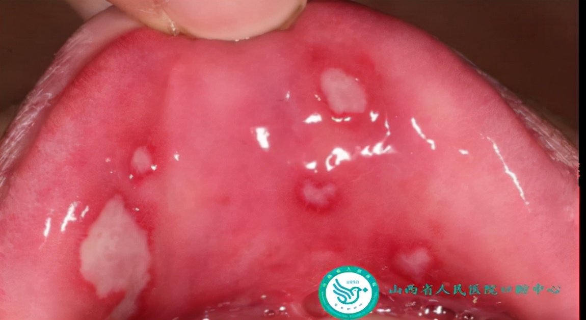 口腔溃疡反反复复咋办,口腔溃疡反反复复发热