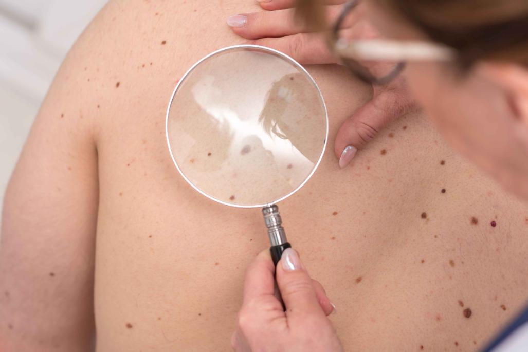 警惕这些痣可能会成瘤,哪些地方有痣代表得癌症了