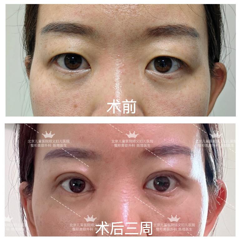 肿眼泡适合什么双眼皮手术,内双适合做双眼皮手术吗