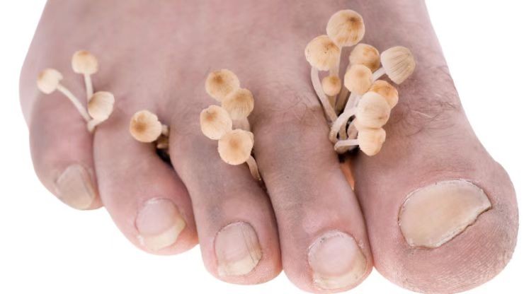 真菌感染怎么预防,足部真菌感染怎么解决