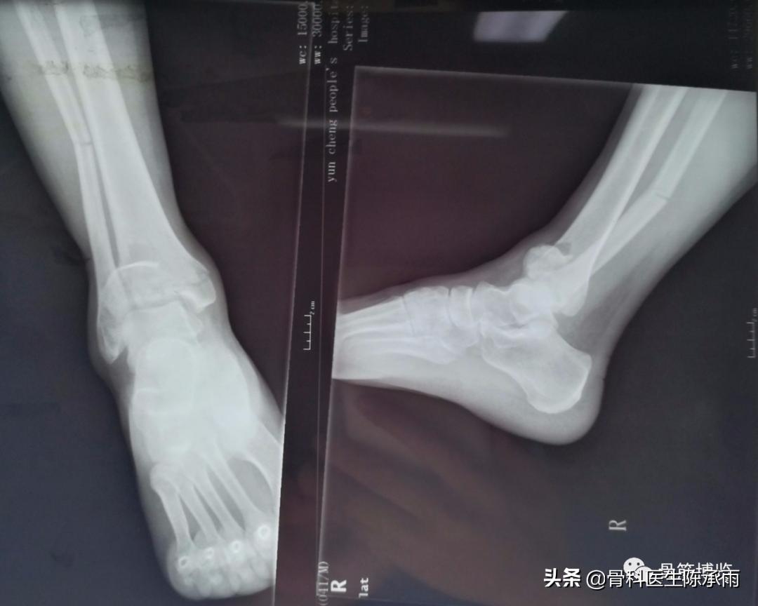 鑴氳笣楠ㄦ姌澶栧浐瀹氭敮鏋跺悗鎬庝箞鎭㈠,鑴氳笣楠ㄦ姌鐭宠啅鍜屽浐瀹氭敮鍏峰摢涓ソ