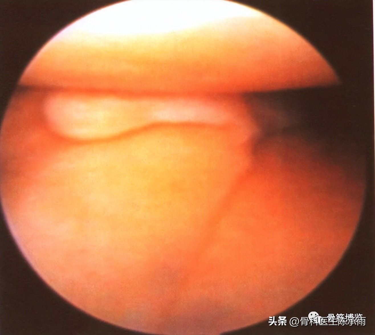 盘状半月板撕裂一级,半月板层裂愈合概率