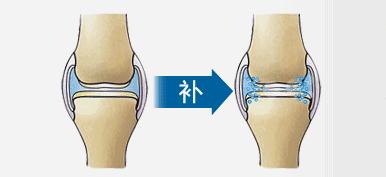 软骨保护类药有哪些,软骨保护关节吗
