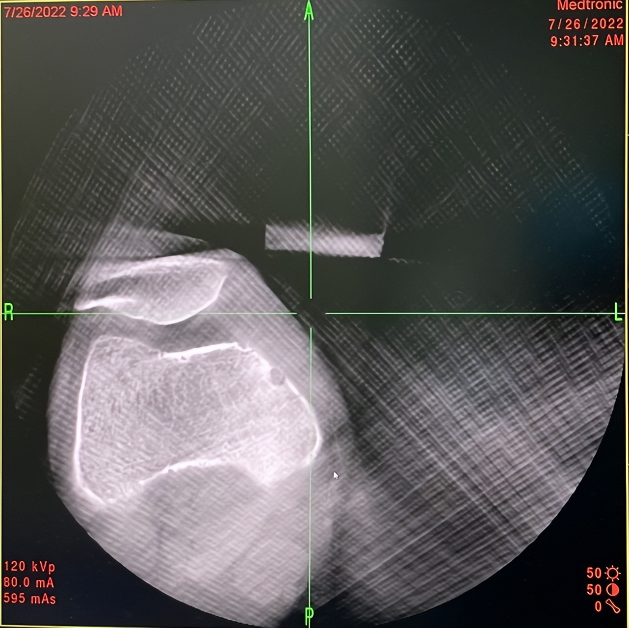 西安市红会医院康复疼痛科,西安红会康复疼痛科