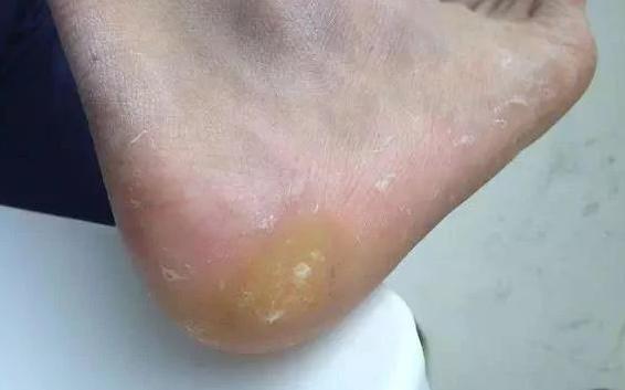 脚上长了类似瘊子又像老茧的东西,长在脚上的鸡眼和疣的区别