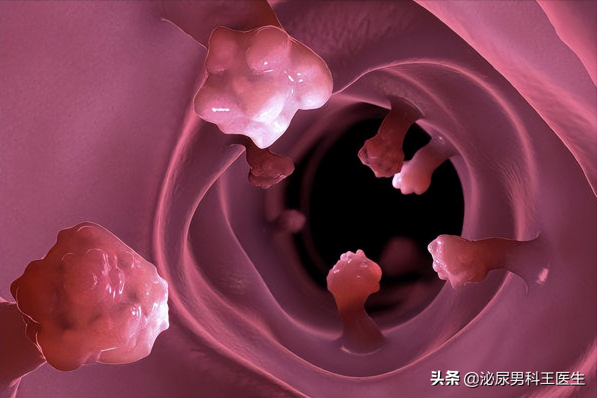 “难以启齿”的肛管癌，你了解它吗？出现3个症状，及时就医检查
