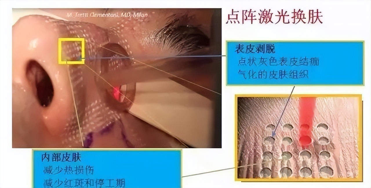 点阵激光是用来干嘛的,点阵激光的副作用和危害