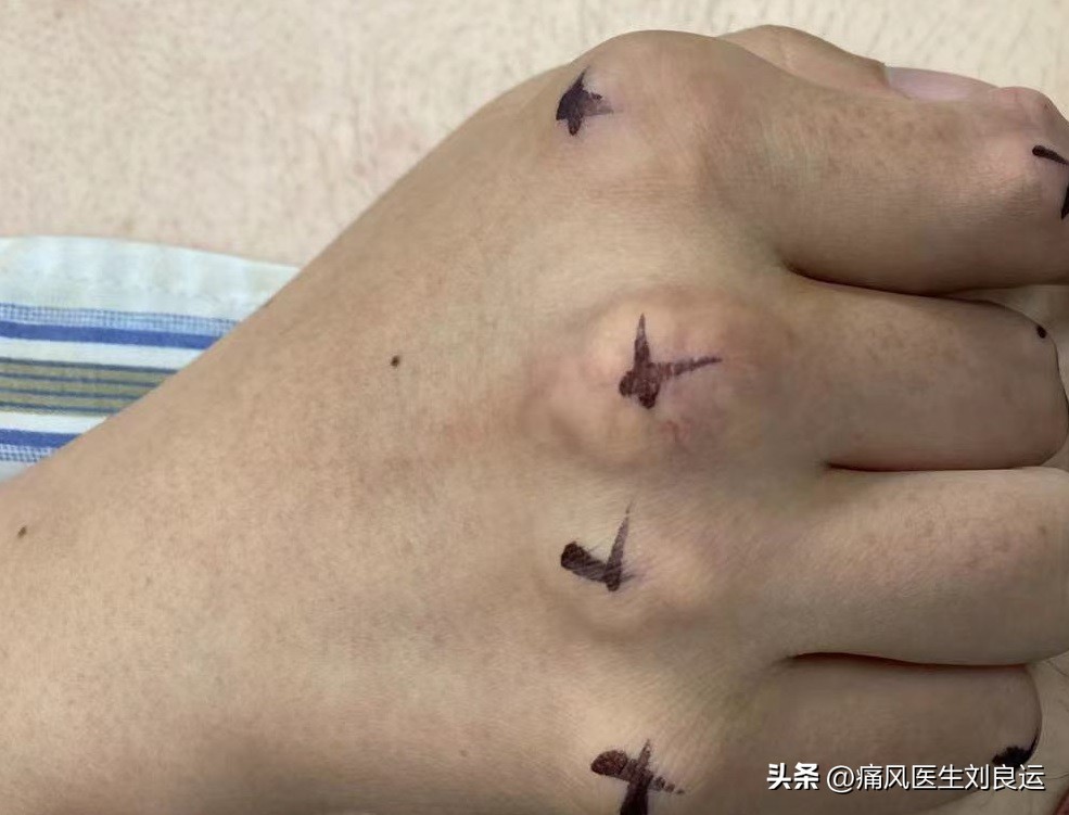 尿酸偏高无痛风症状怎么降尿酸,痛风所有尿酸升高均需降尿酸