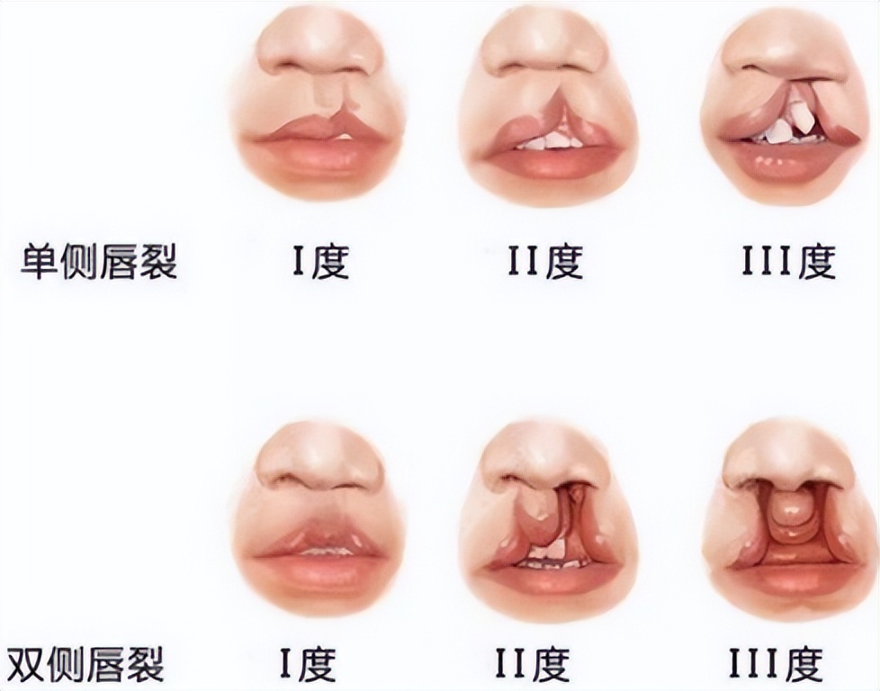 轻微唇裂可以完全修复好吗,唇裂做地包天矫正可以吗