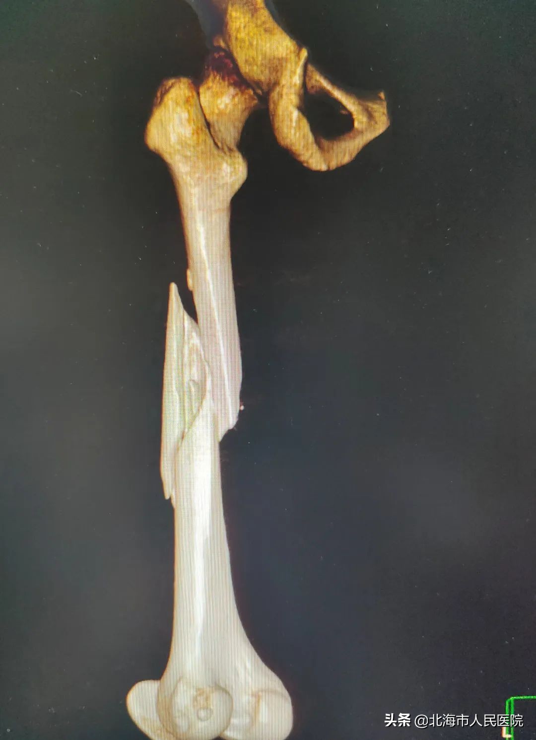 男子足球撞门柱,男子踢球被断球摔倒骨折