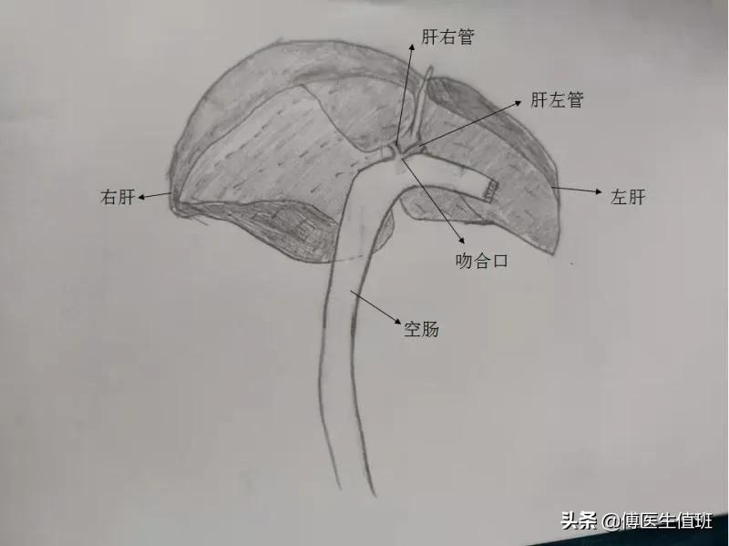 男子吃鸡后腹胀、腹泻，医院检查发现转氨酶升高，医生：胰腺肿瘤