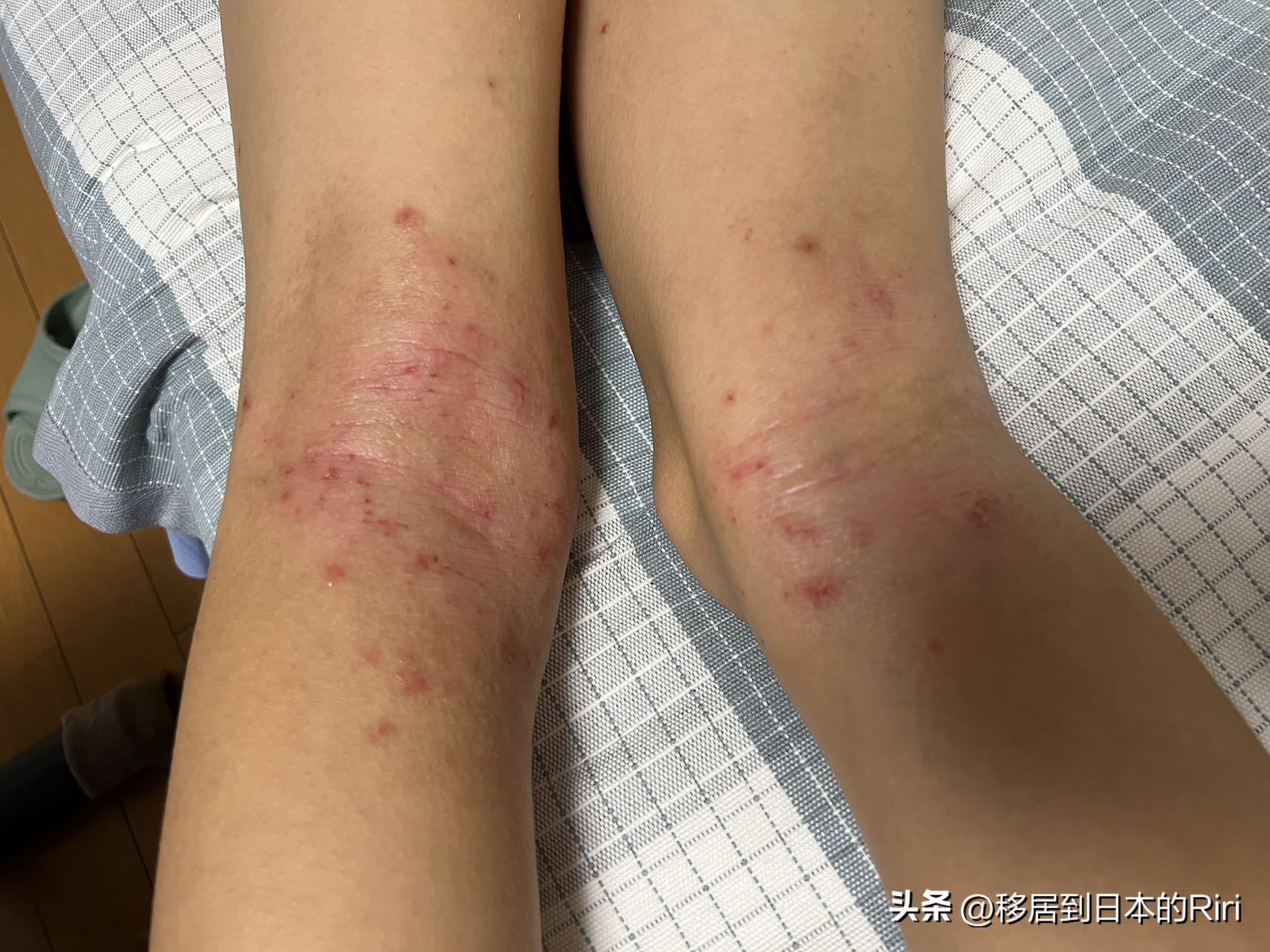 日本神经性皮炎,日本过敏性皮炎