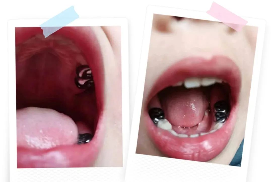 乳牙坏了不疼医生说神经坏了,乳牙坏了不用管