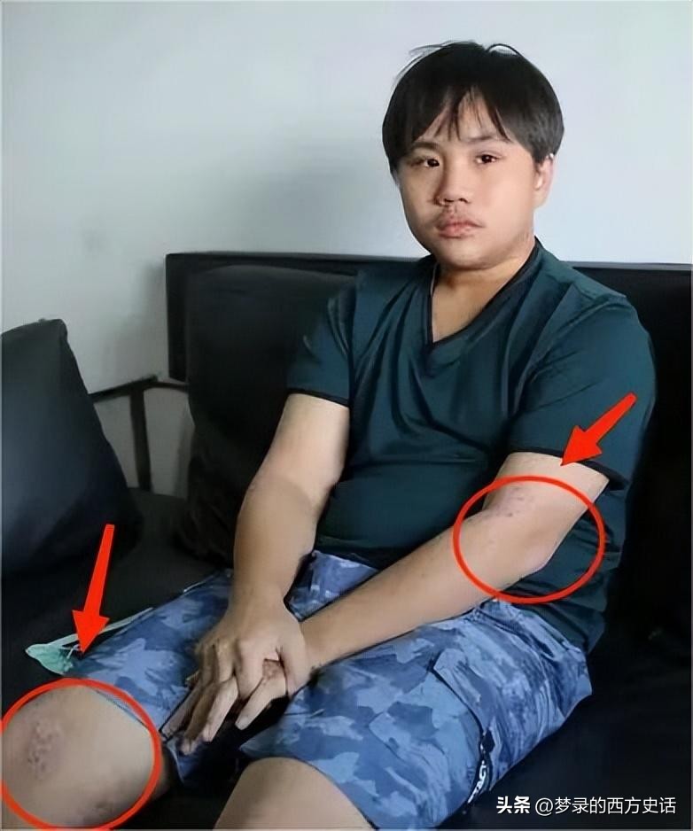 皮肤溃烂的童星,童星打促进生长激素后真实经历