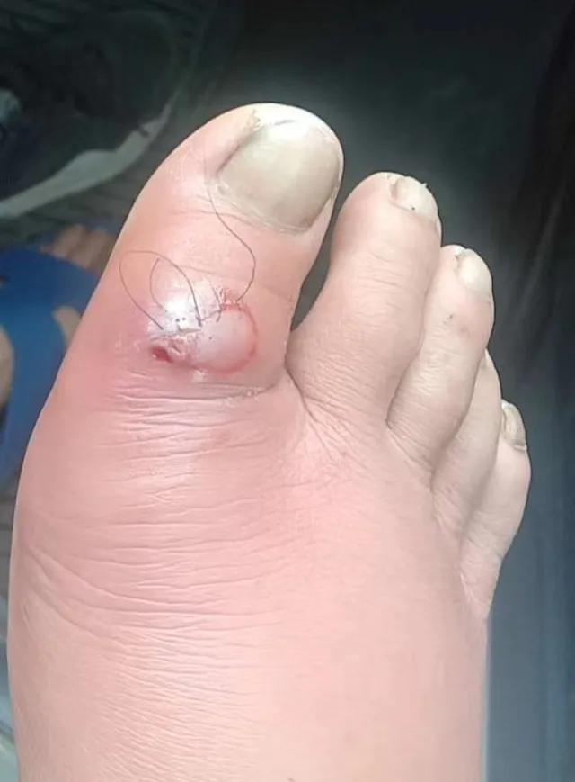 在医院做一个脓包手术大概多少钱,脓包治疗需要多少钱