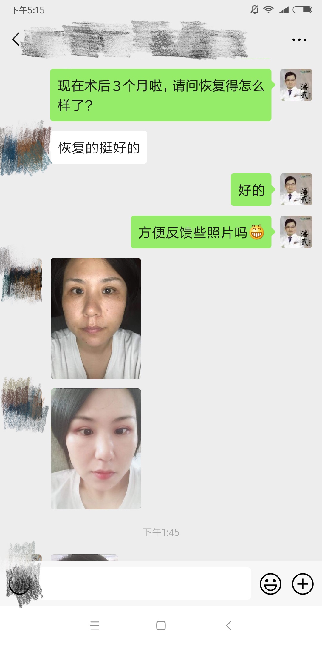 东莞整形做双眼皮,东莞整形医院割双眼皮