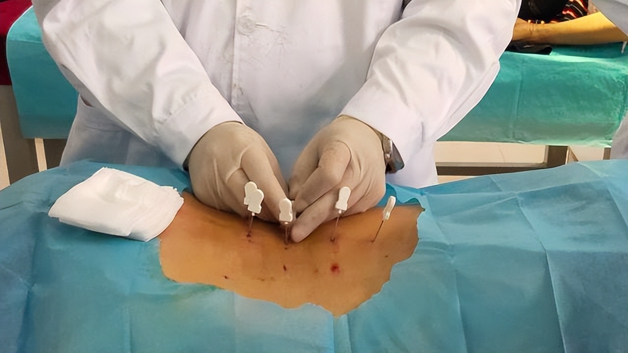 真正好的腰椎间盘突出治疗方法,腰椎间盘突出不做有效治疗的后果