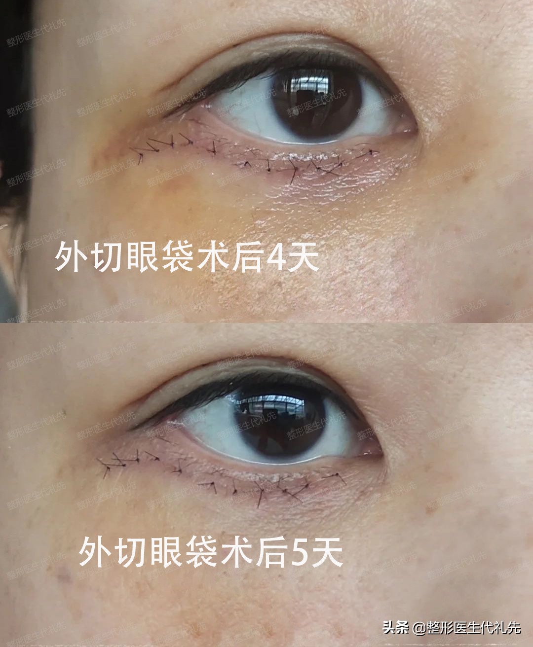 外切眼袋手术警惕三大后遗症,外切眼袋手术后多长时间恢复正常