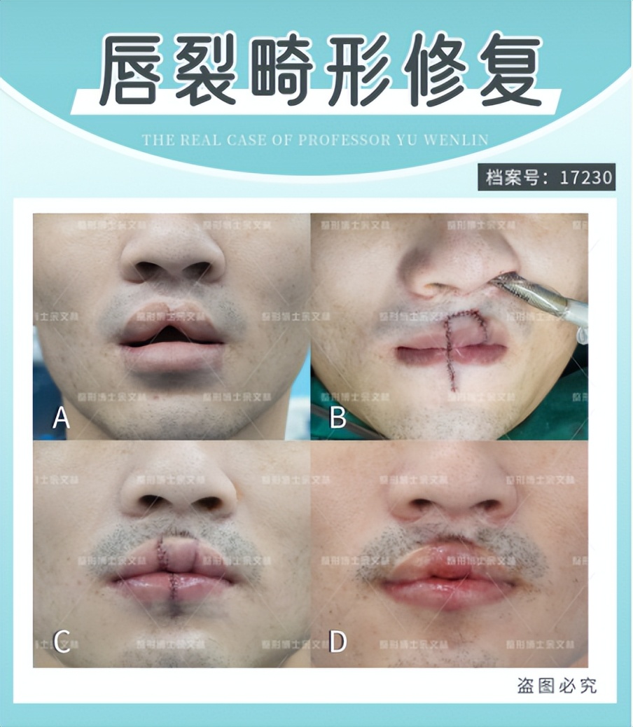 兔唇可以修复吗,兔唇修复能和正常人一样吗