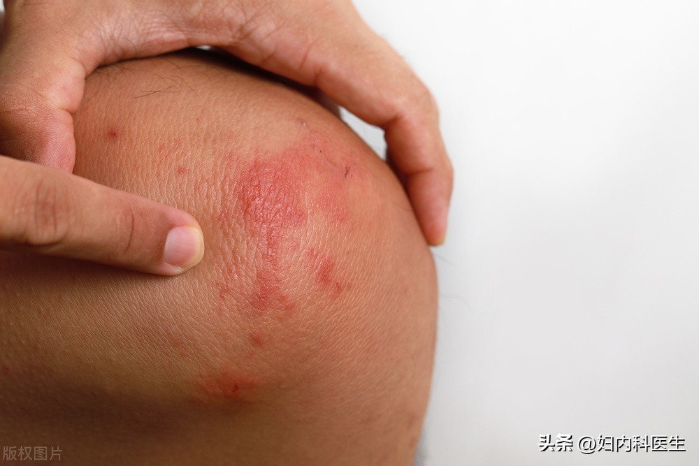 支原体感染的疾病该如何应用阿奇霉素抗菌？医生一文告诉您