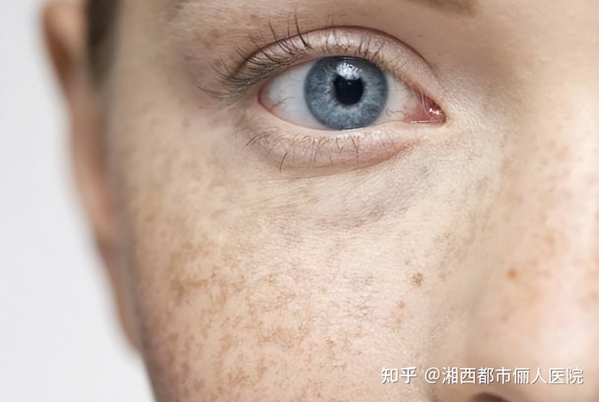 褐斑怎么去除才可以清除掉,褐斑怎样才能彻底的去掉