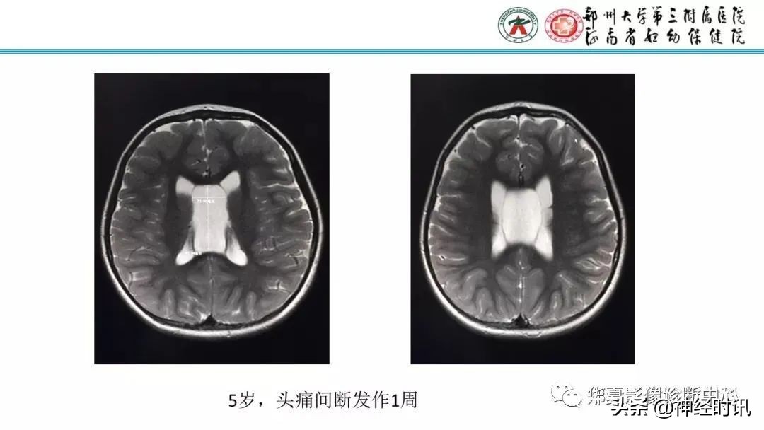 透明隔腔影像诊断,25张ppt
