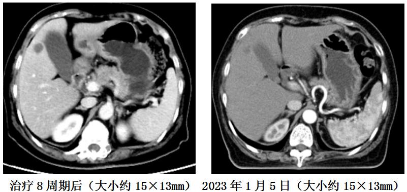 全国治胃癌最好的化疗方案,肿瘤科常见化疗方案解读
