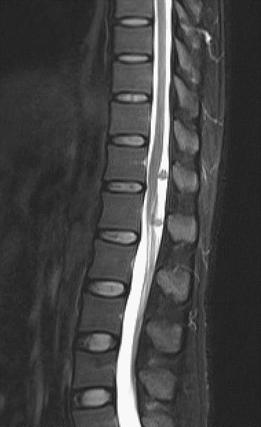 脊柱多发血管瘤手术指征,椎管内良性肿瘤有哪些