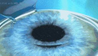 哪种近视手术对散光矫正更好,大散光为什么适合做近视矫正手术