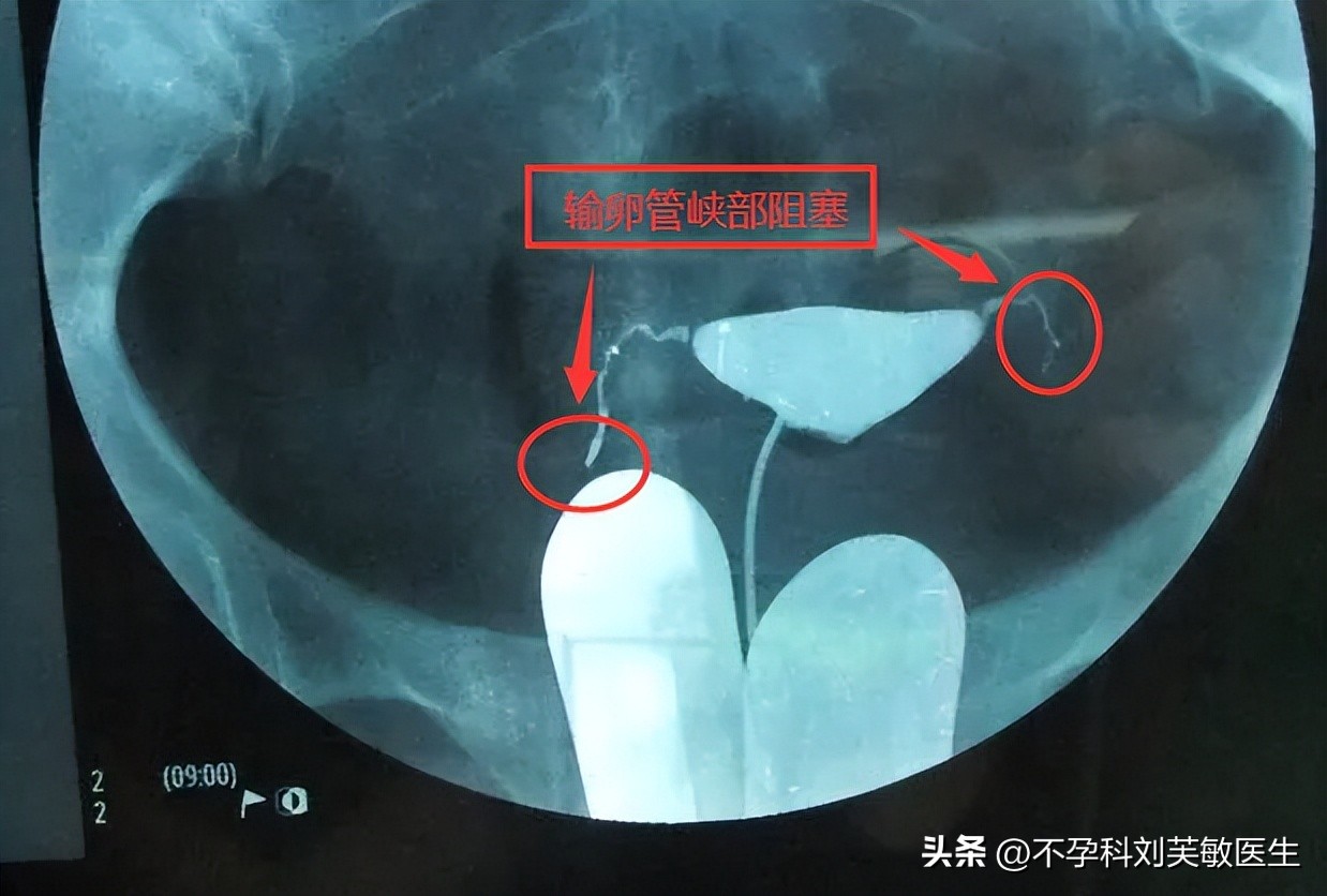 输卵管造影步骤图片解读,如何看懂输卵管造影片子