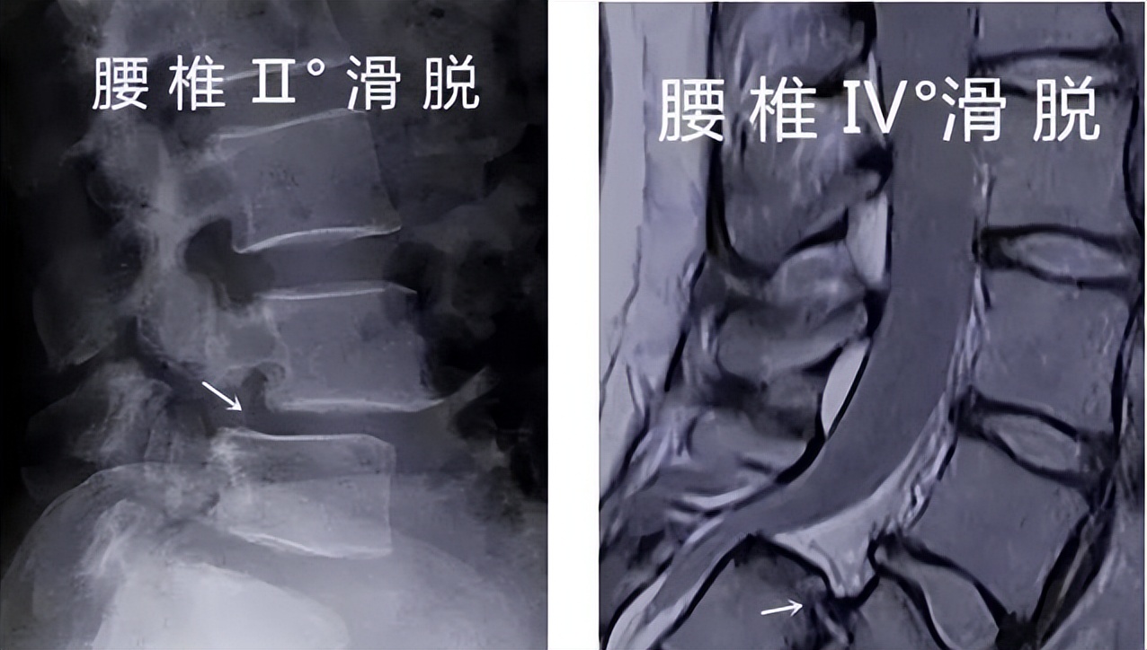 腰椎滑脱手术微创更贵还是开刀贵,腰椎滑脱真性与假性滑脱症状区别
