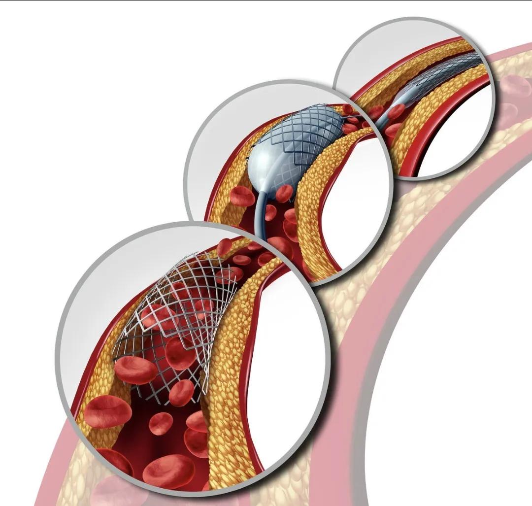 冠心病支架手术后肺会不好吗,冠心病做完支架后支架会移动吗