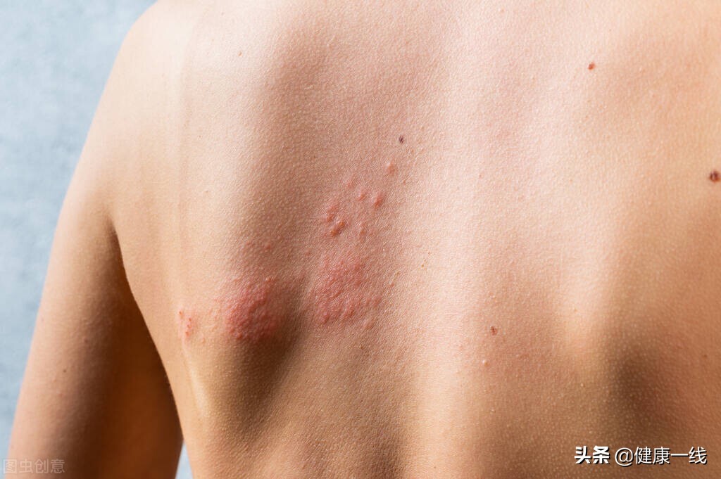 得了脂溢性皮炎怎么办好有效,脂溢性皮炎发作时如何应对