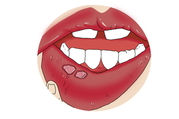 身上有癌的10个皮肤征兆,身体内有癌皮肤有几种表现