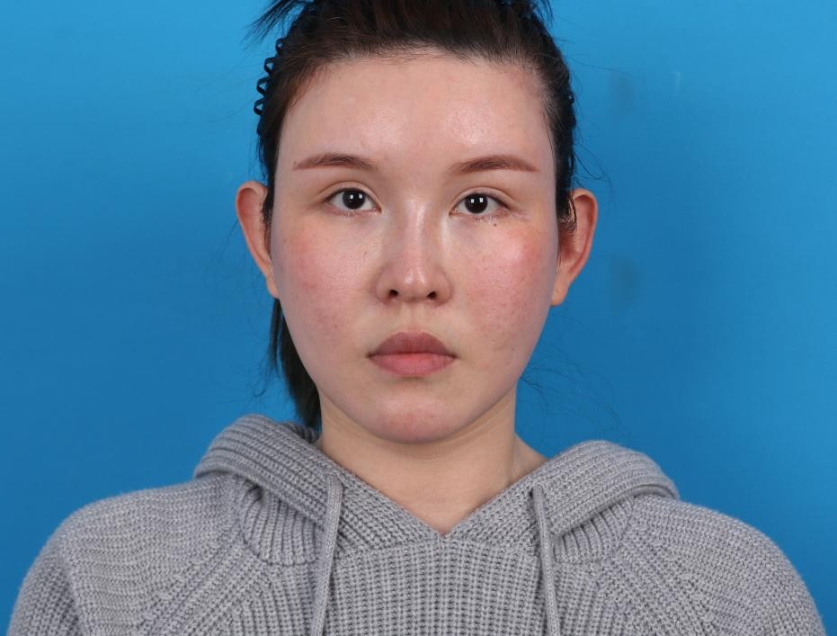 做了线雕隆鼻变丑了,我想变美怎么办