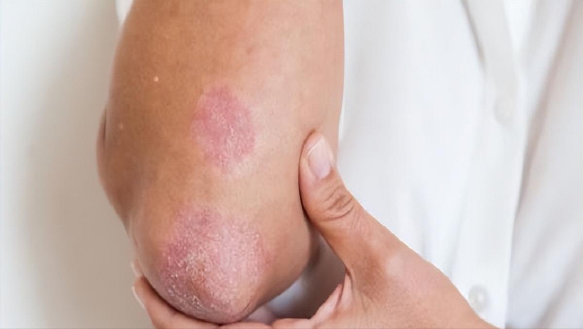 银屑病中医辨证论治根源,中药外用治银屑病研究进展