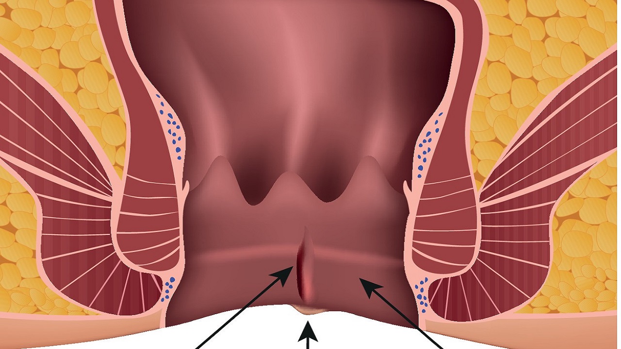 24岁女生肛裂正常吗,16岁女孩经常肛裂怎么治疗