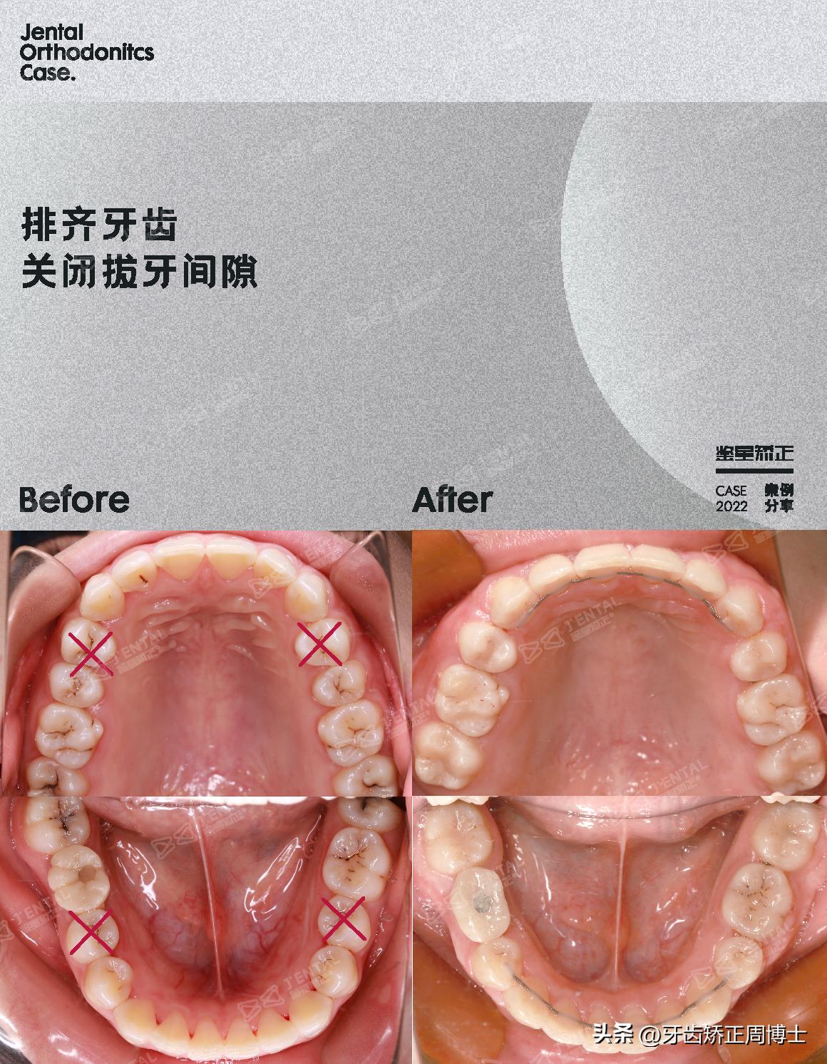 骨性前突正畸后多长时间有效果,牙性下巴后缩可以戴牙套改善吗