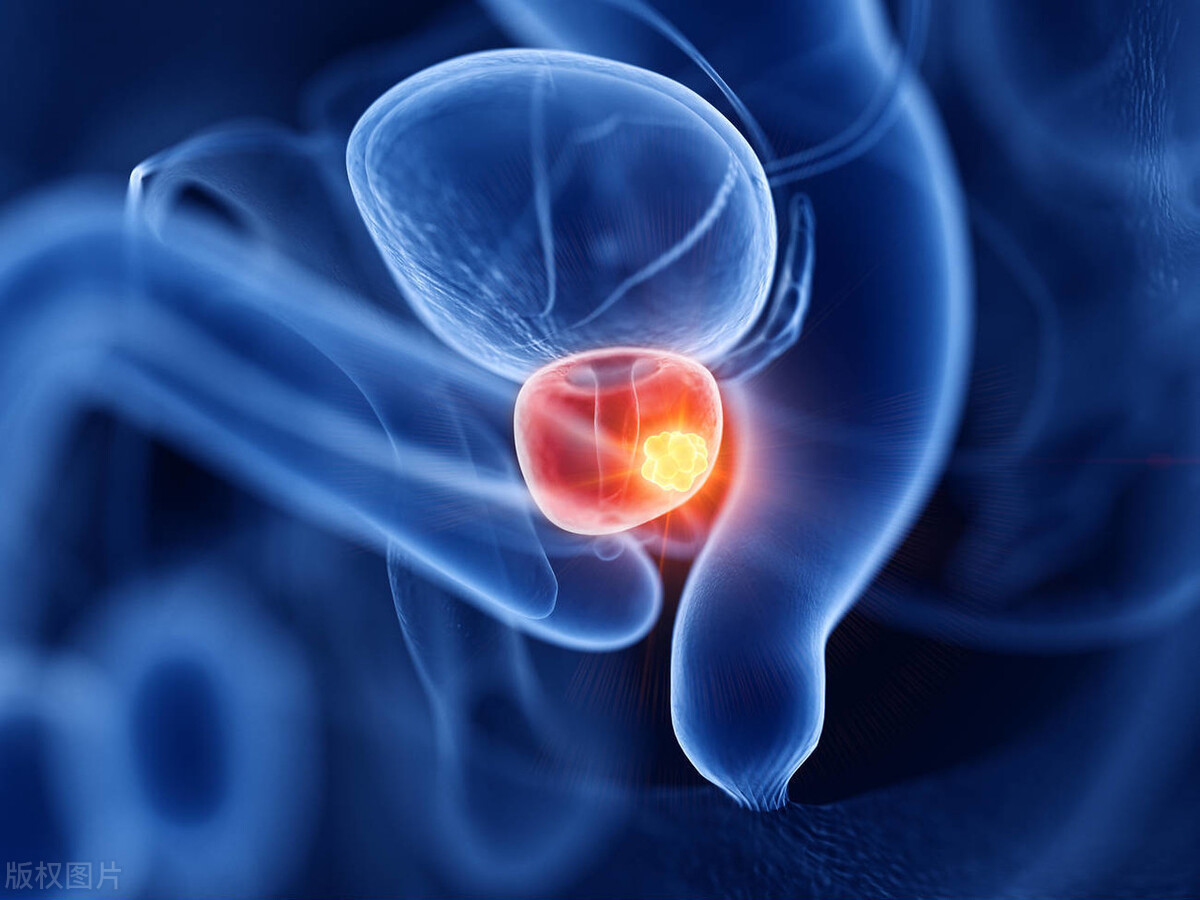 阴茎癌病因病机中医,阴茎癌的发病原因是什么呢