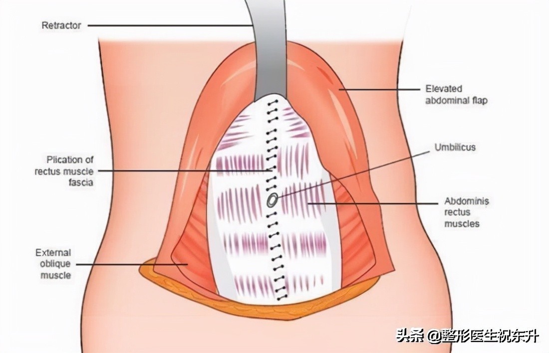 做完腹壁整形有什么好的改善,说说做手术感受